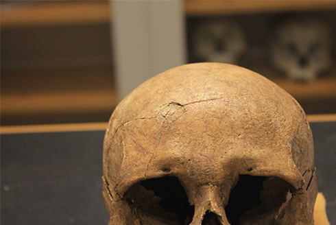 From the Viking skeletal study: A skull displaying blunt force trauma with radiating lines. | Photo credit: Lisa Mariann Strand