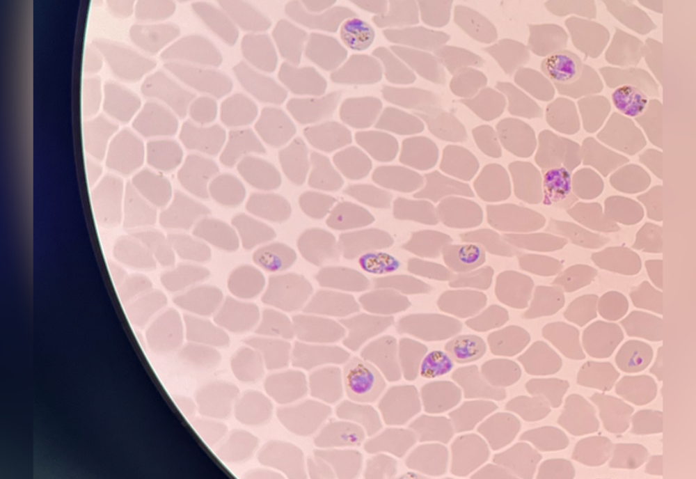 A look through the microscope at malaria parasite Plasmodium knowlesi, a representative of the most geographically wide-spread malaria parasites, in human blood. The parasites are the dark-colored structures inside the cells. 