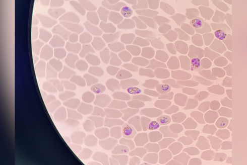 A look through the microscope at malaria parasite Plasmodium knowlesi, a representative of the most geographically wide-spread malaria parasites, in human blood. The parasites are the dark-colored structures inside the cells. 